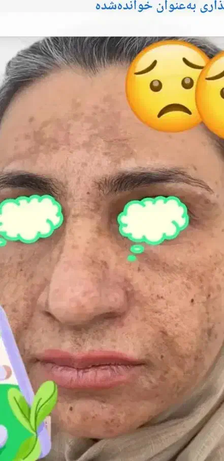 فرمول سفید کننده تضمینی صد درصد طی سه روز نتیجه|آرایشی، بهداشتی، درمانی|ایرانشهر, |دیوار