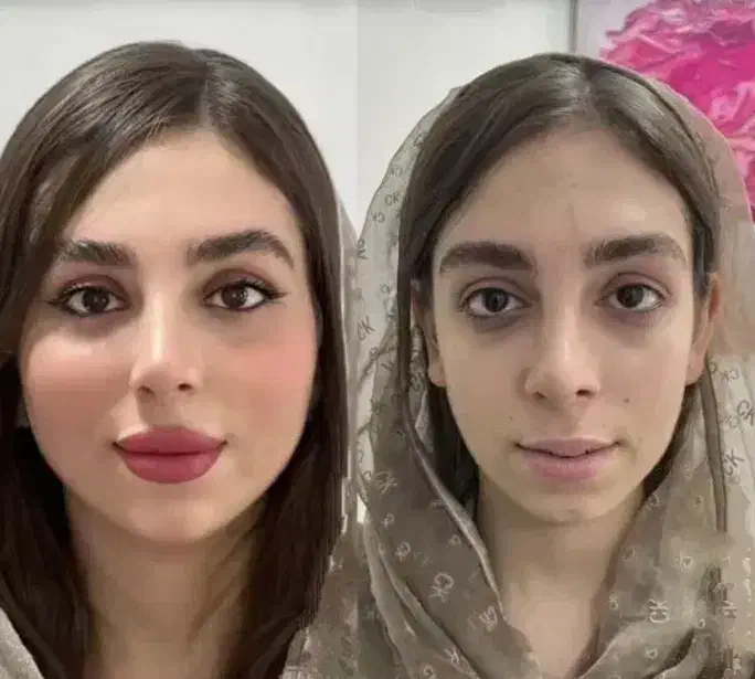 مزونیدلینگ ژل و بوتاکس|خدمات آرایشگری و زیبایی|یاسوج, |دیوار