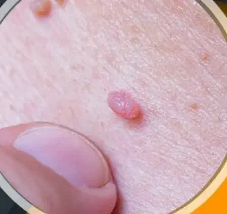 درمان خال گوشتی|آرایشی، بهداشتی، درمانی|کوهدشت, |دیوار