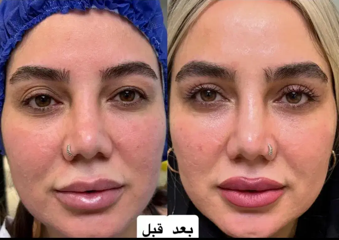 جشنواره عمل پلک فقط ۷ میلیون به مدت محدود|خدمات زیبایی و سلامت|کرمانشاه, |دیوار