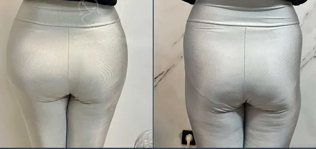 تخفیف پاییزی تنها مرکز تخصصی فیلر بادی نسیم شهر|خدمات آرایشگری و زیبایی|نسیمشهر, |دیوار