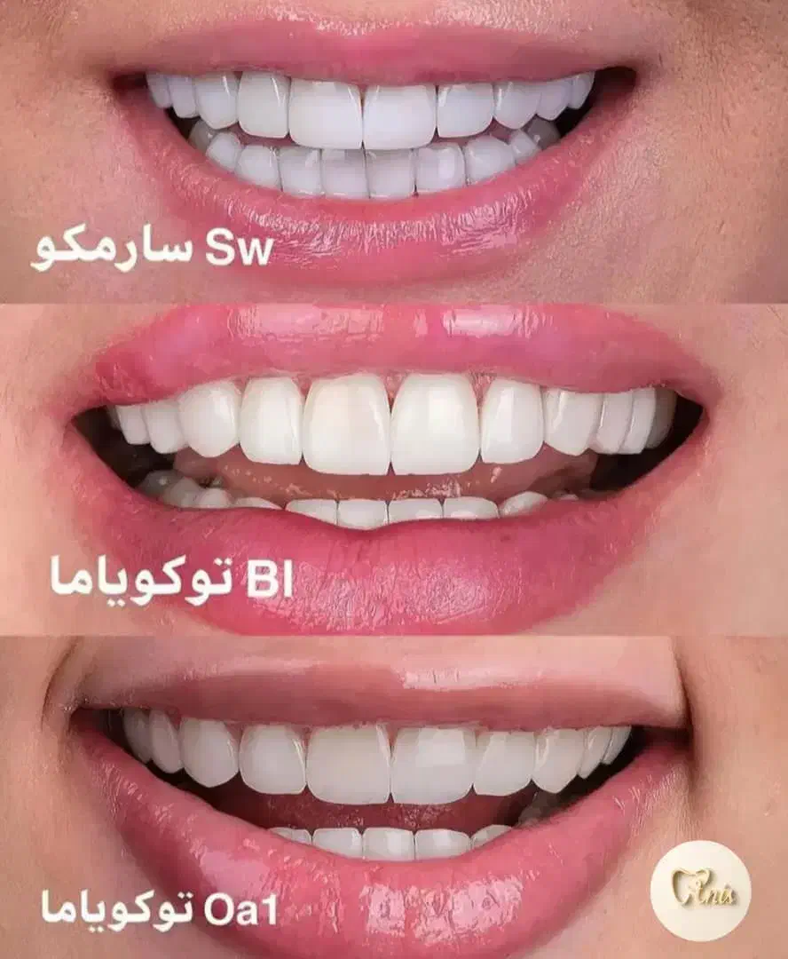 عصب کشی ترمیم کامپوزیت|خدمات آرایشگری و زیبایی|قم, نوقطار|دیوار