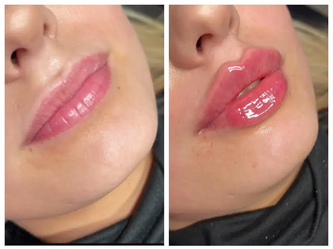 جشنواره تزریق ژل و بوتاکس (توسط پزشک)|خدمات آرایشگری و زیبایی|اصفهان, عباسآباد|دیوار