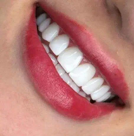 خدمات کامپوزیت،روکش،دندان مصنوعی|خدمات آرایشگری و زیبایی|چهاردانگه (تهران), |دیوار