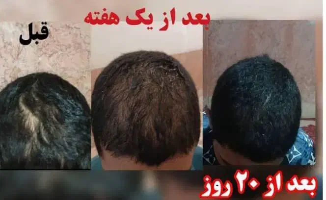 درمان ریزش مو قطعی|فعالیت داوطلبانه|قیدار, |دیوار