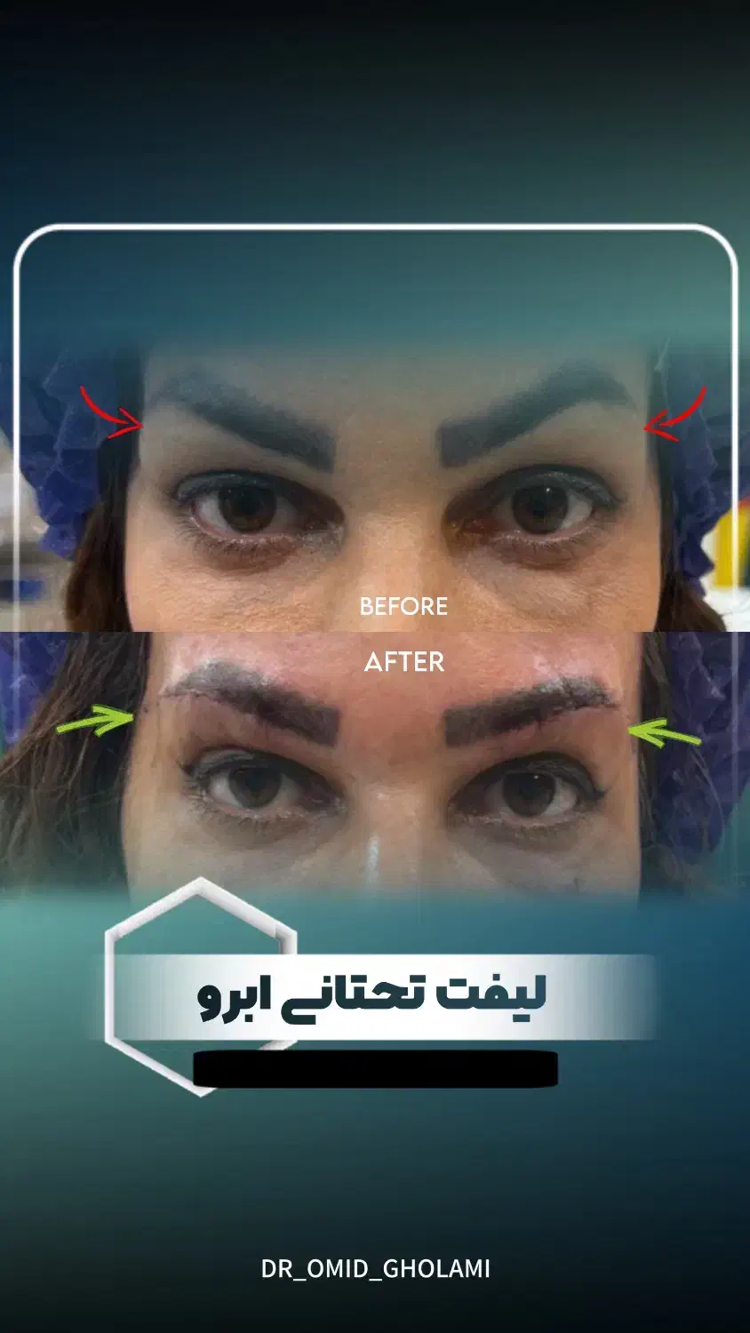 بلفارو/ لیفت صورت و ابرو/غبغب/تزریق چربی با تخفیف|خدمات آرایشگری و زیبایی|مشهد, سجاد شهر|دیوار