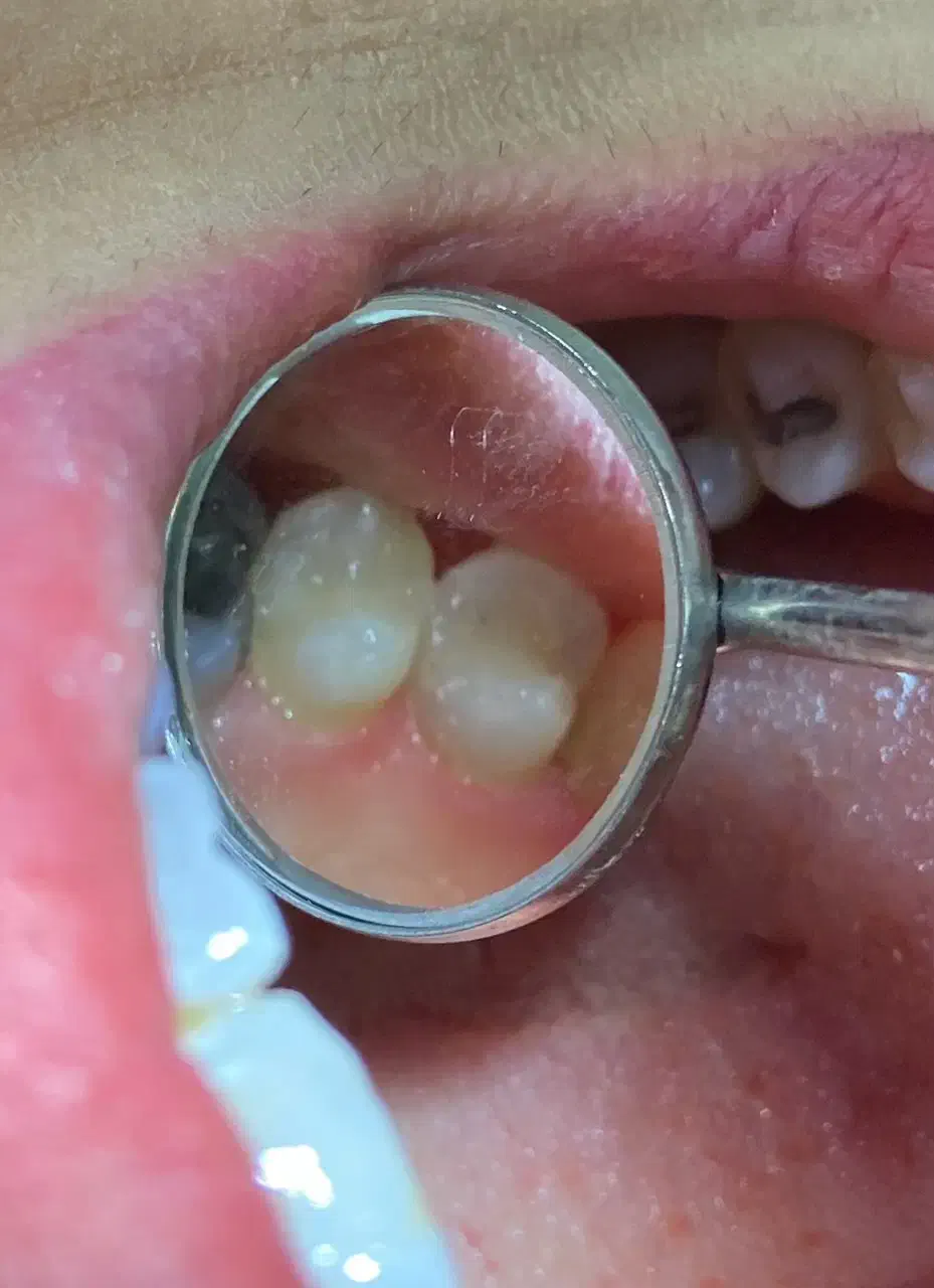 ترمیم و عصب کشی دندان تعرفه بسیار پایین  قصردشت|خدمات آرایشگری و زیبایی|شیراز, میرزاکوچک خان|دیوار