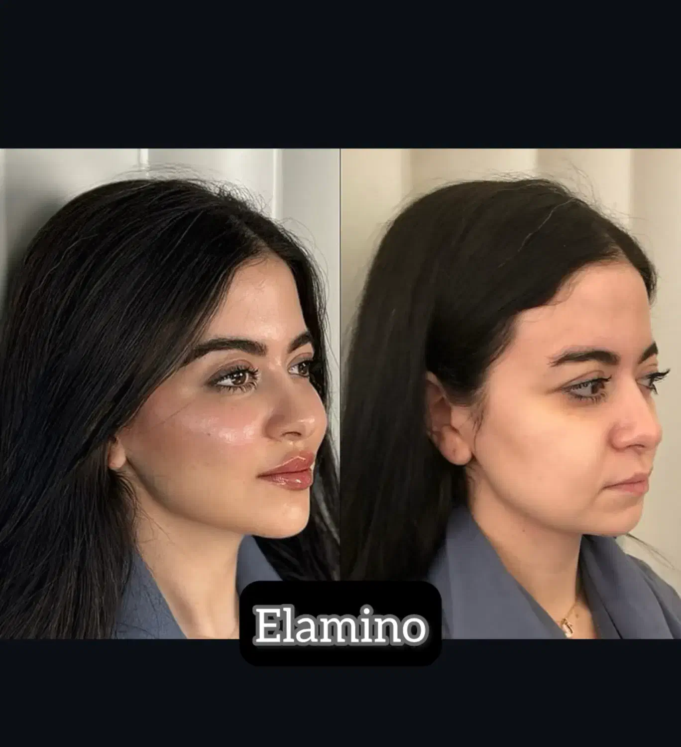 تزریق ژل بوتاکس فیلر در کلینیک زیبایی تهران|خدمات آرایشگری و زیبایی|تهران, یافت آباد جنوبی|دیوار