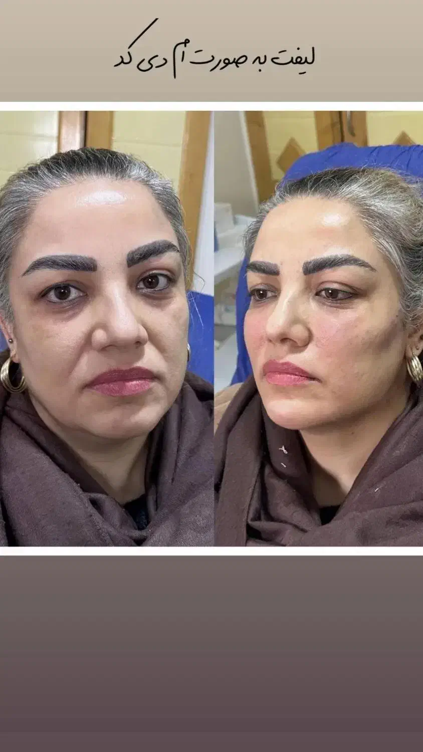 مدل برای درمان افتادگی های صورت و ژل لب و بوتاکس|خدمات آرایشگری و زیبایی|تهران, میرداماد|دیوار