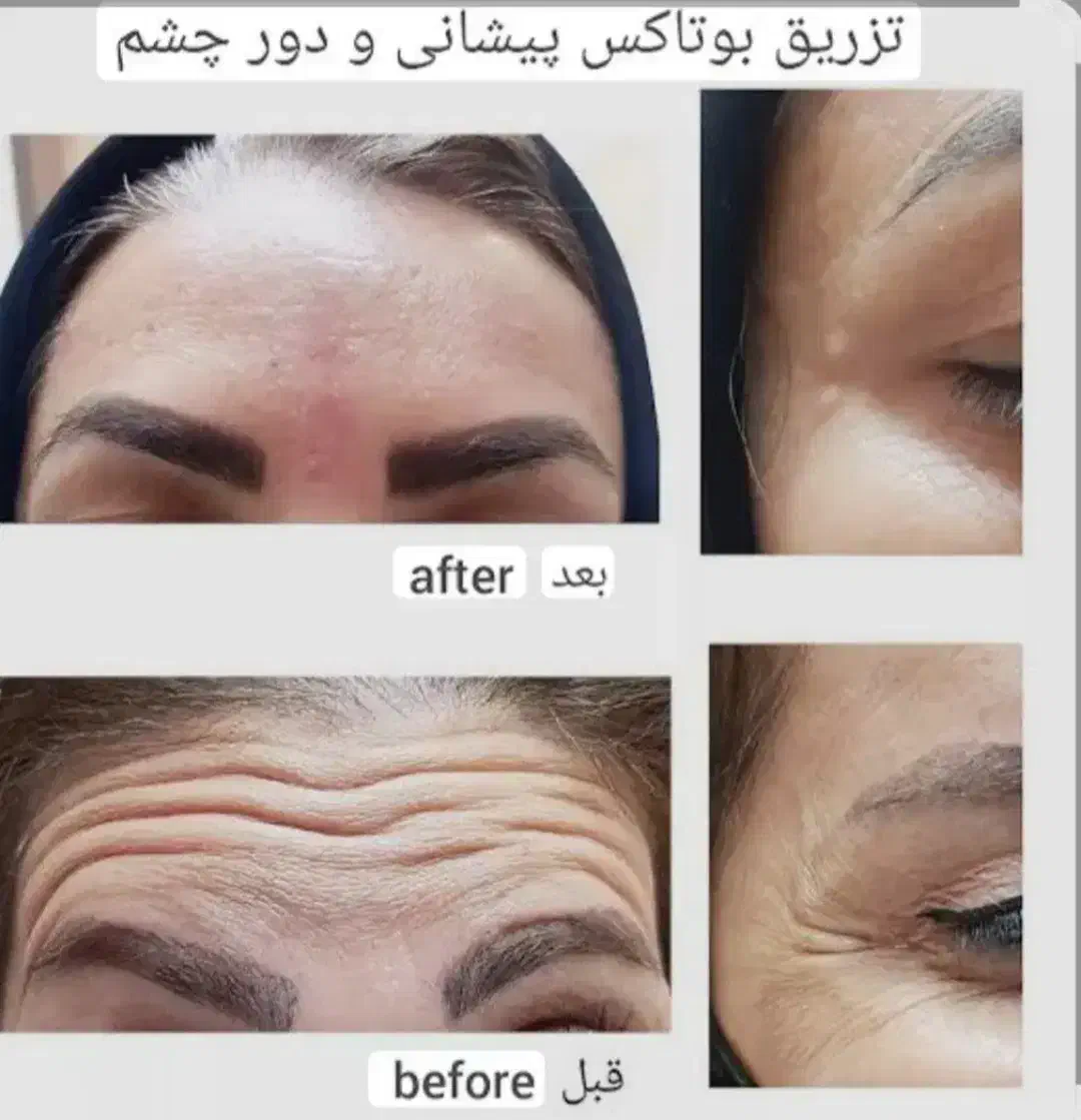 ژل و بوتاکس و برداشتن خال|خدمات آرایشگری و زیبایی|اهواز, زرگان|دیوار