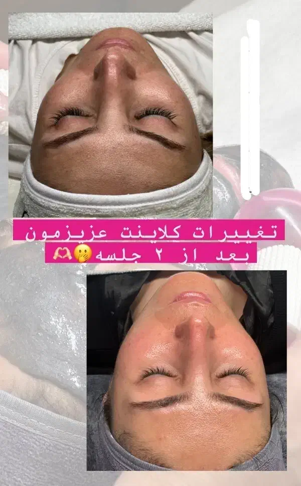 فشیال پوست تقویت مو درمطب پزشک ویژه بانوان وآقایان|خدمات آرایشگری و زیبایی|شیراز, رازی|دیوار
