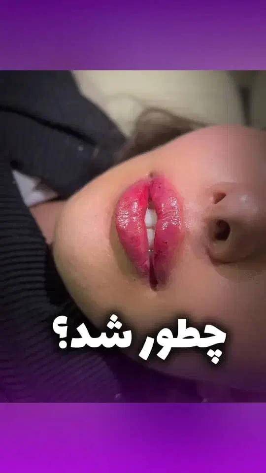 فیلر لب بوتاکس بلفاروپلاستی تخلیه غبغب مزوتراپی|خدمات آرایشگری و زیبایی|اندیشه, اندیشه فاز ۳|دیوار