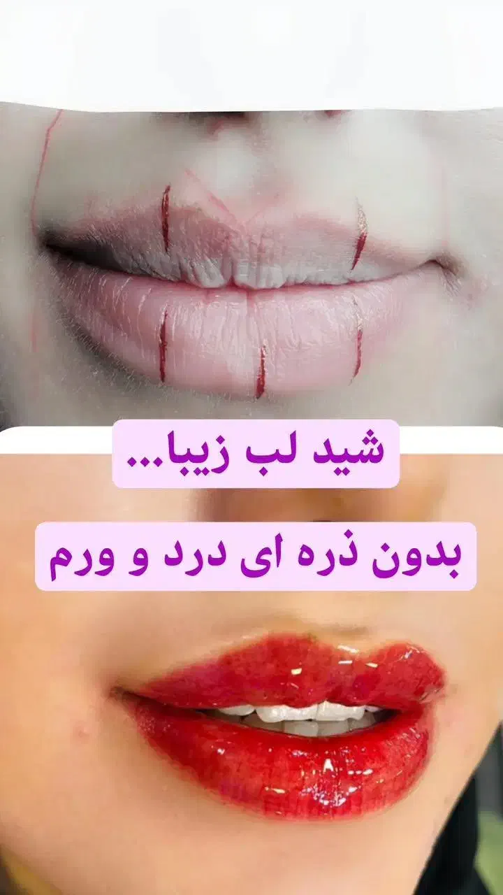 میکروبلیدینگ وشی لب درمنزل شما باقیمت باورنکردنی|خدمات آرایشگری و زیبایی|کرمان, |دیوار