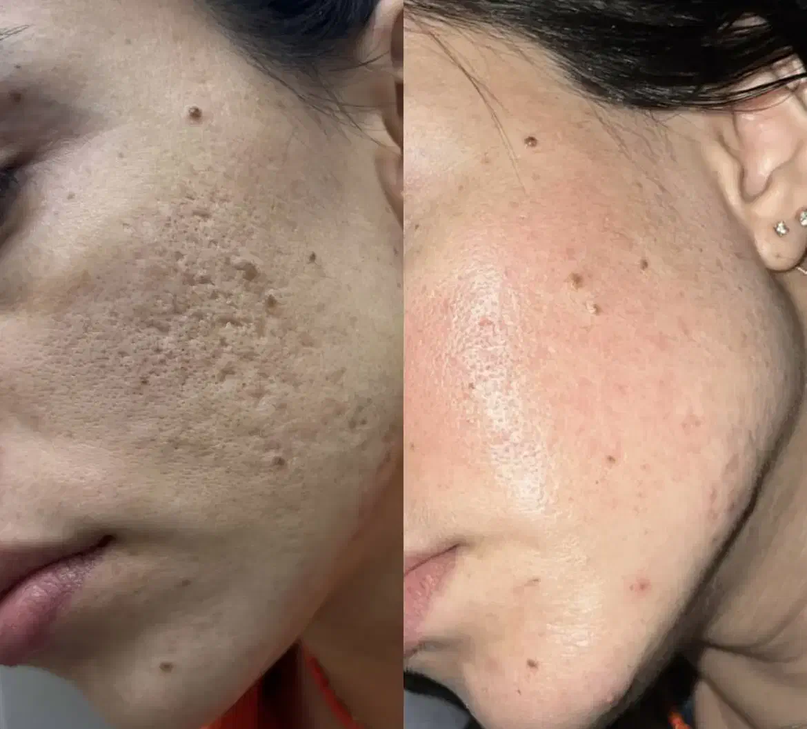 از بین بردن لک و جای جوش فرورفته صورت گچساران|خدمات آرایشگری و زیبایی|دهدشت, |دیوار