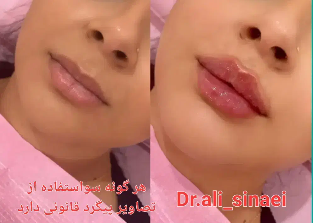 جشنواره تزریق فیلر و ژل و بوتاکس در قلب پزشکی مشهد|خدمات آرایشگری و زیبایی|مشهد, احمدآباد|دیوار