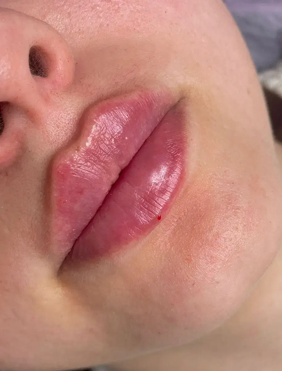 بوتاکس کل صورت ۷۵۰ هزارتومان  ژل لب و صورت|خدمات آرایشگری و زیبایی|رشت, دباغیان|دیوار