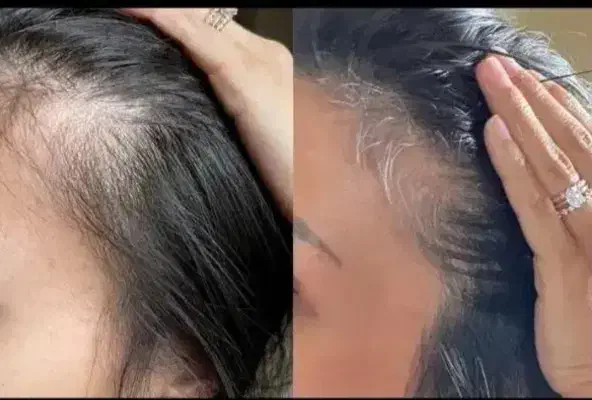 قطع مشکلات مربوط به ریزش مو|آرایشی، بهداشتی، درمانی|تهران, شهرک آزمایش|دیوار