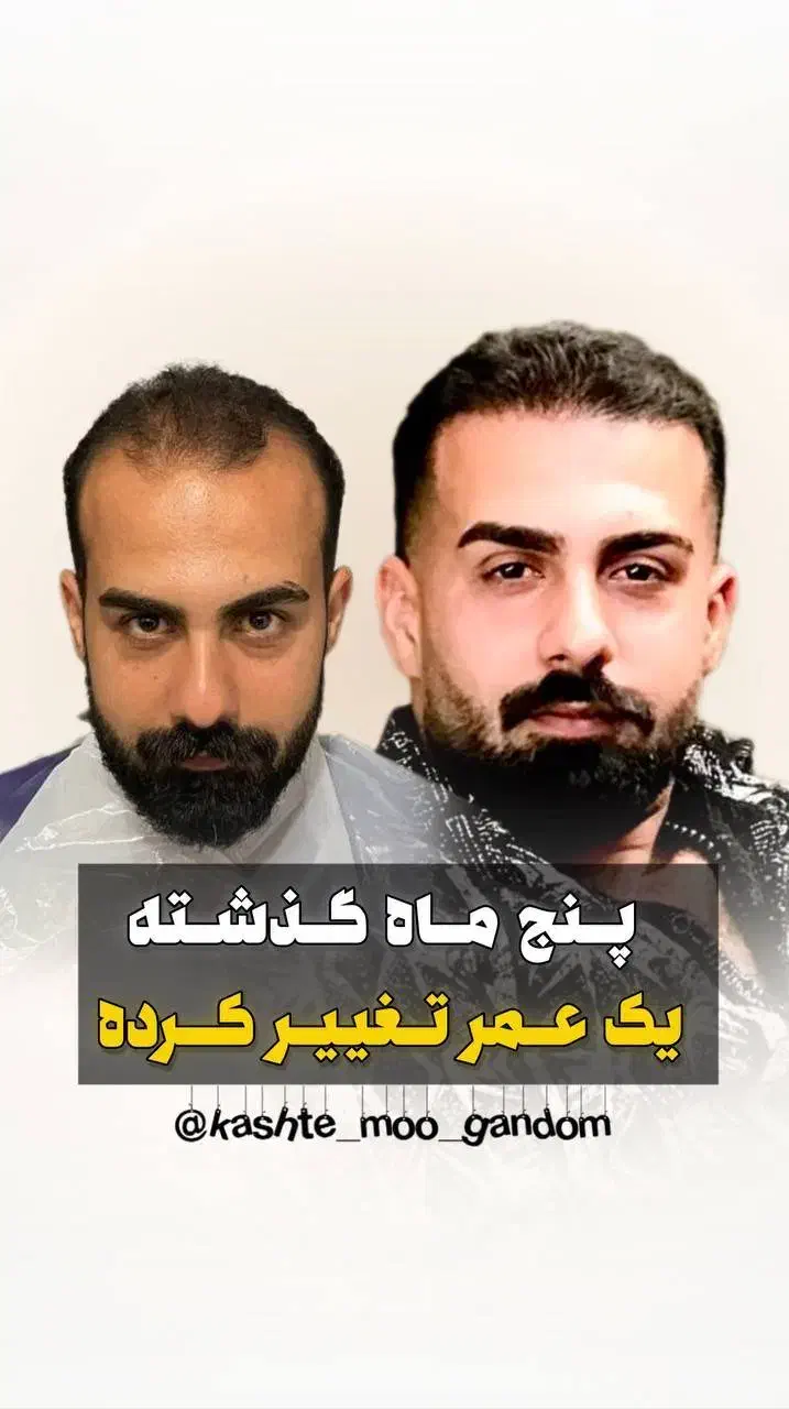 کاشت مو و ابرو و ریش|خدمات آرایشگری و زیبایی|شیراز, قدوسی غربی|دیوار