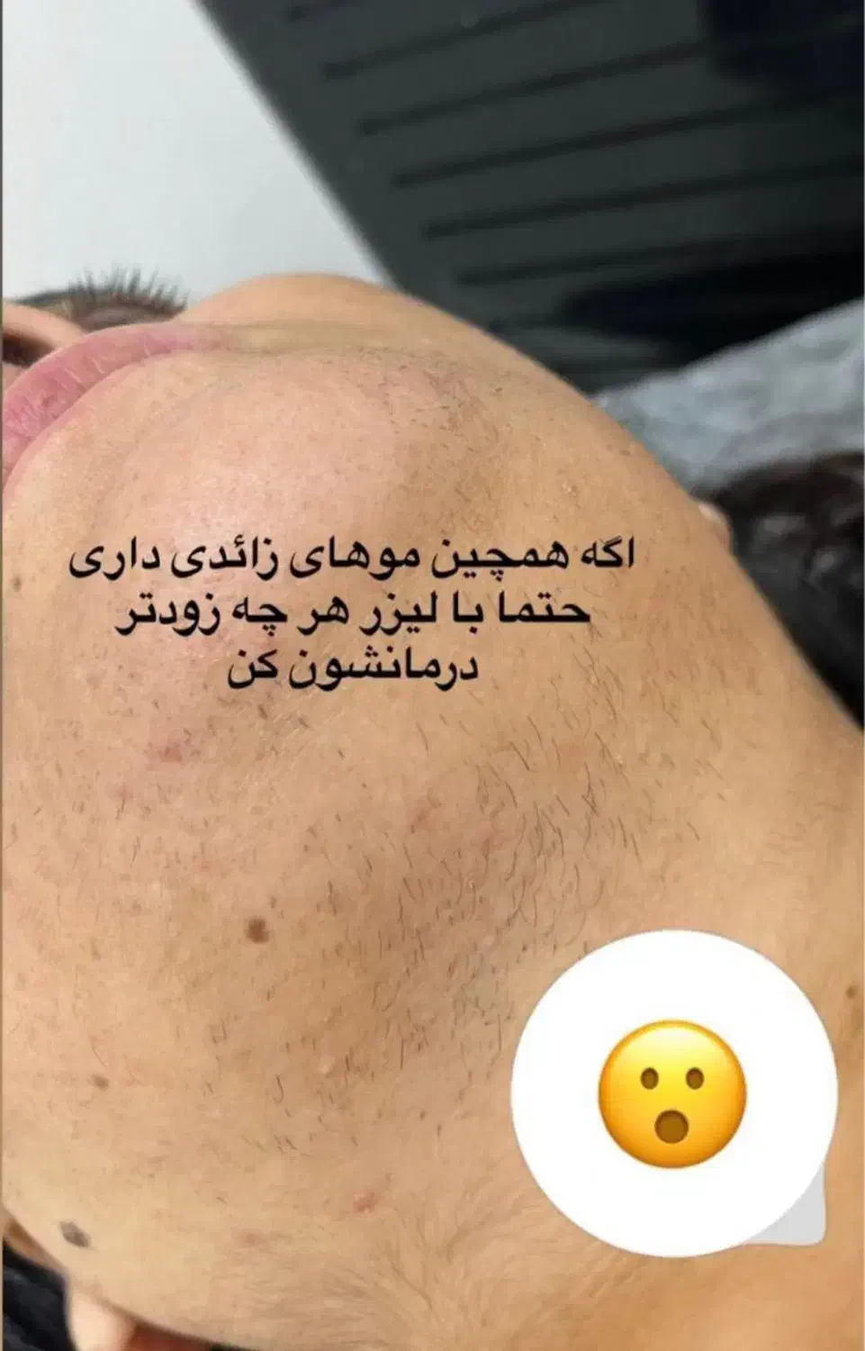 لیزرموهای زائد وپلاژن ترابی ویژه بانوان|خدمات آرایشگری و زیبایی|مشهد, توس (بلوار توس)|دیوار