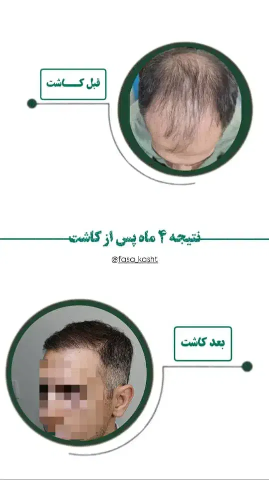 کاشت مو و کاشت اَبرو|خدمات آرایشگری و زیبایی|فسا, |دیوار