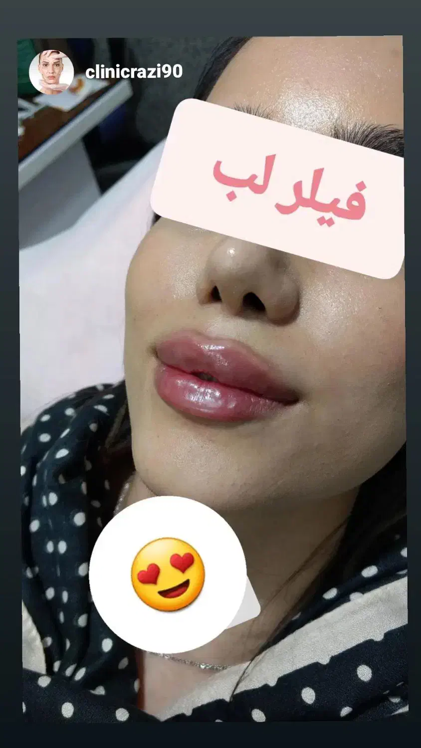 ژل ۹۵۰تومان فیلر بیکینی و باسن هر سی سی ۳۴۰|خدمات آرایشگری و زیبایی|تهران, کیانشهر|دیوار