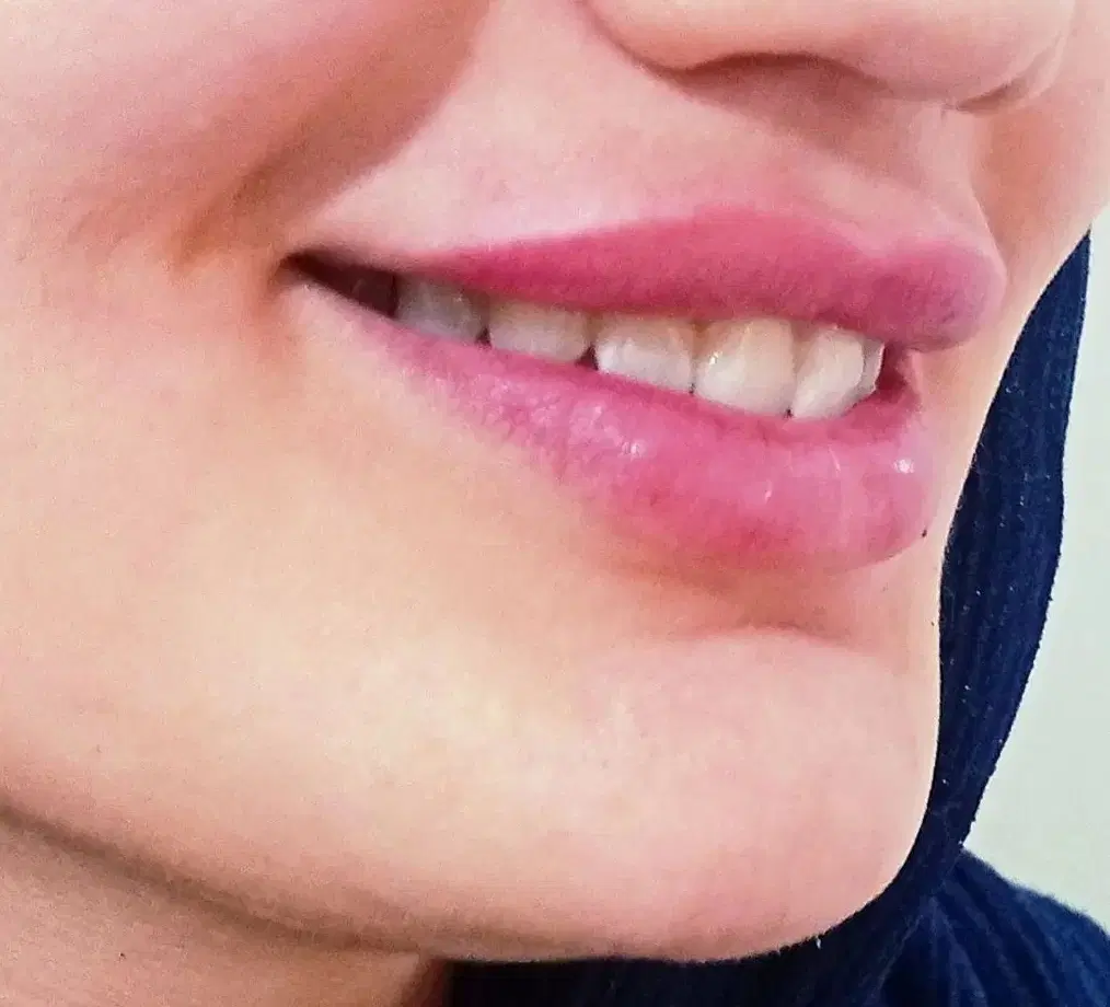 تزریق بوتاکس و ژل در کلینیک(توسط پزشک،)|خدمات زیبایی و سلامت|مشهد, هفت تیر (حافظ)|دیوار
