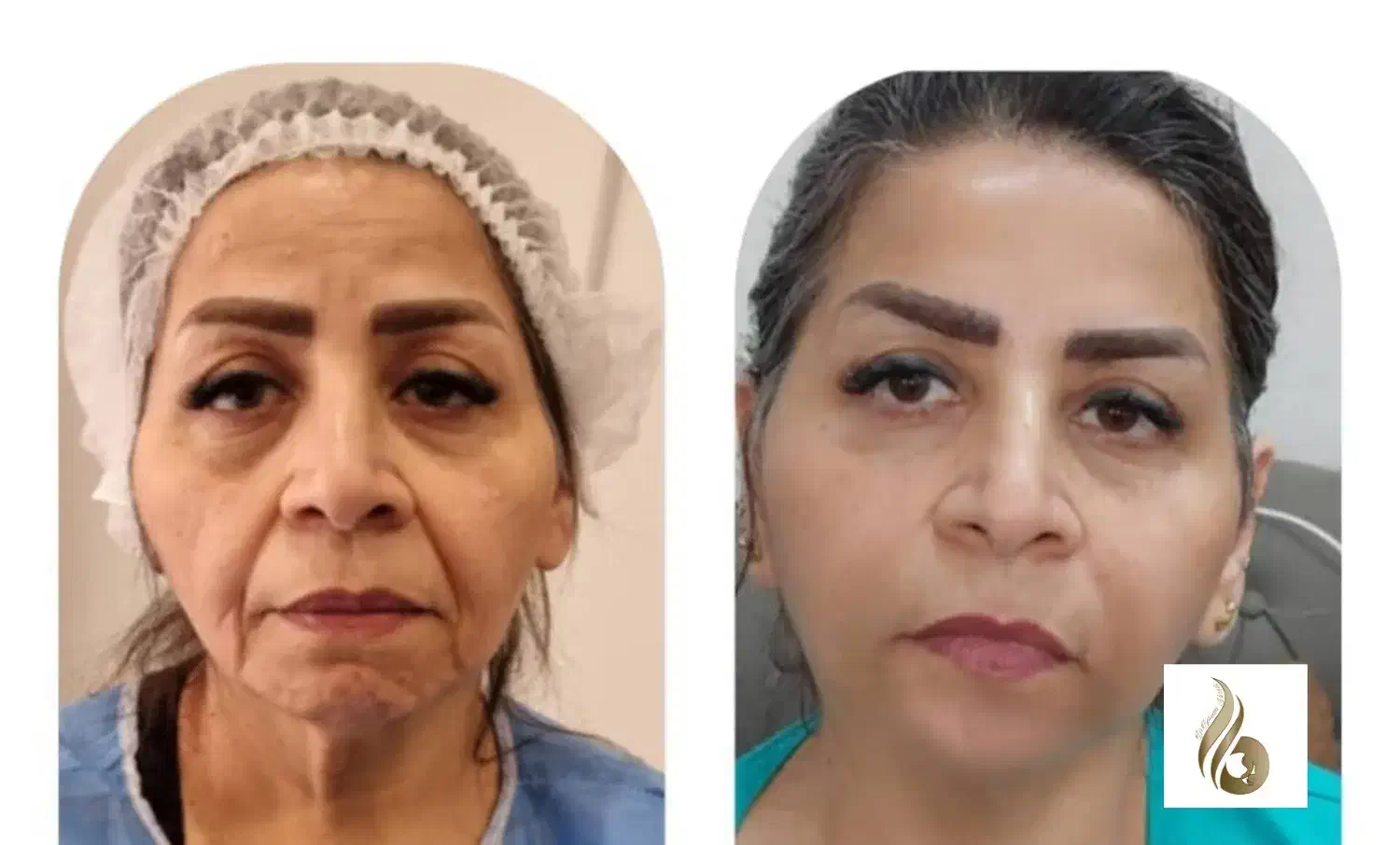 جراحی صورت ۵۰درصد تخفیف|خدمات آرایشگری و زیبایی|تهران, دروس|دیوار