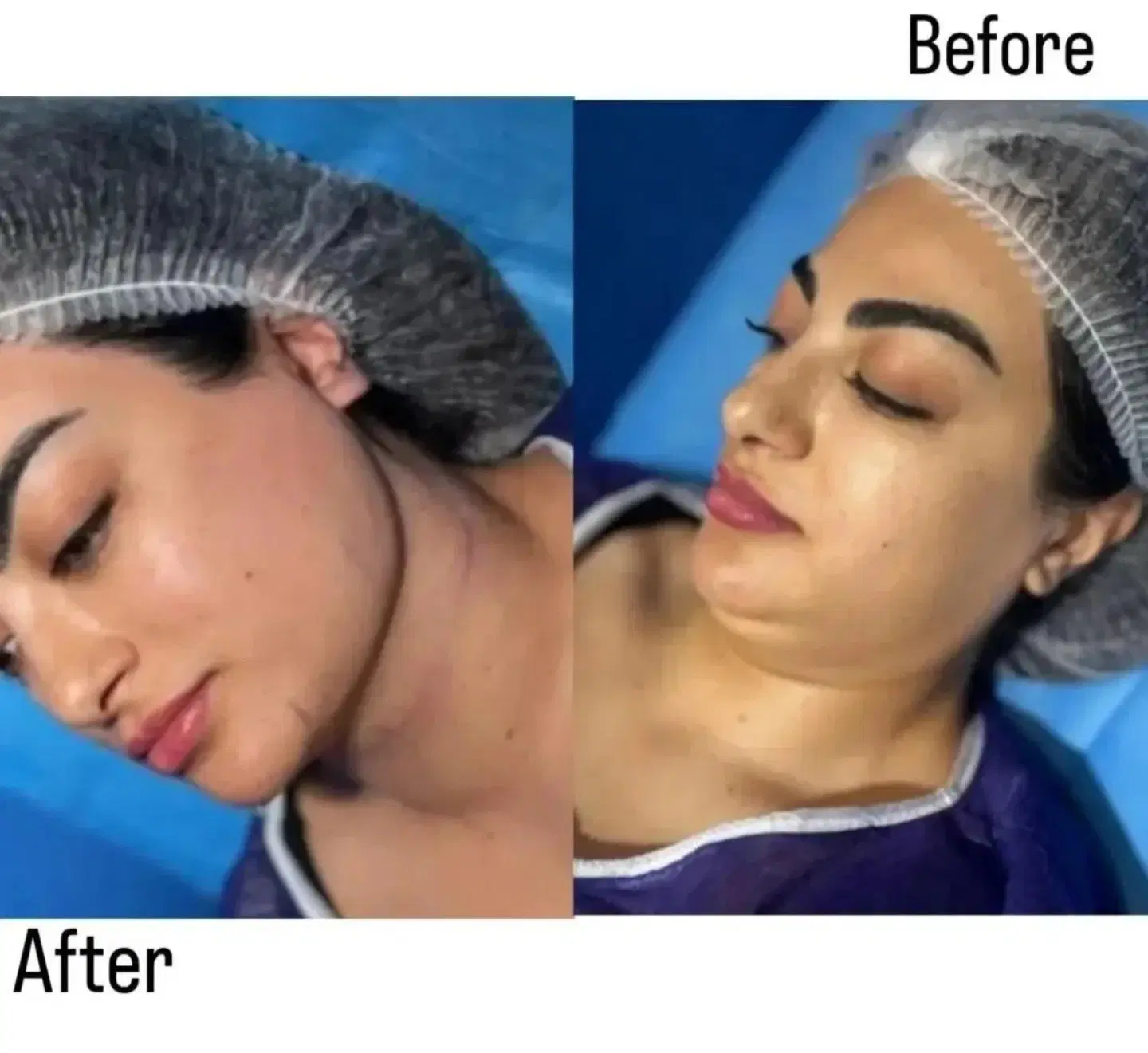 ساکشن|خدمات زیبایی و سلامت|ملایر, |دیوار
