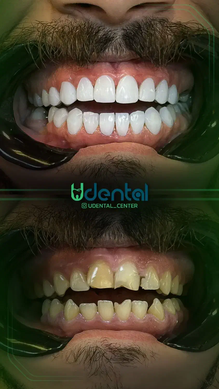 کامپوزیت، لمینت، ایمپلنت اقساط ویژه|خدمات آرایشگری و زیبایی|محلات, |دیوار