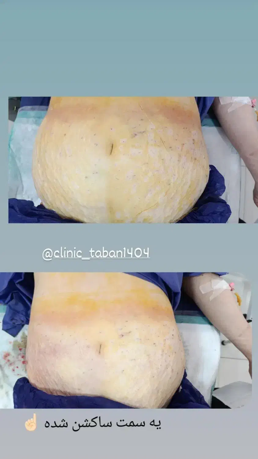 ساکشن وجراحی غبغب|خدمات آرایشگری و زیبایی|کوهدشت, |دیوار