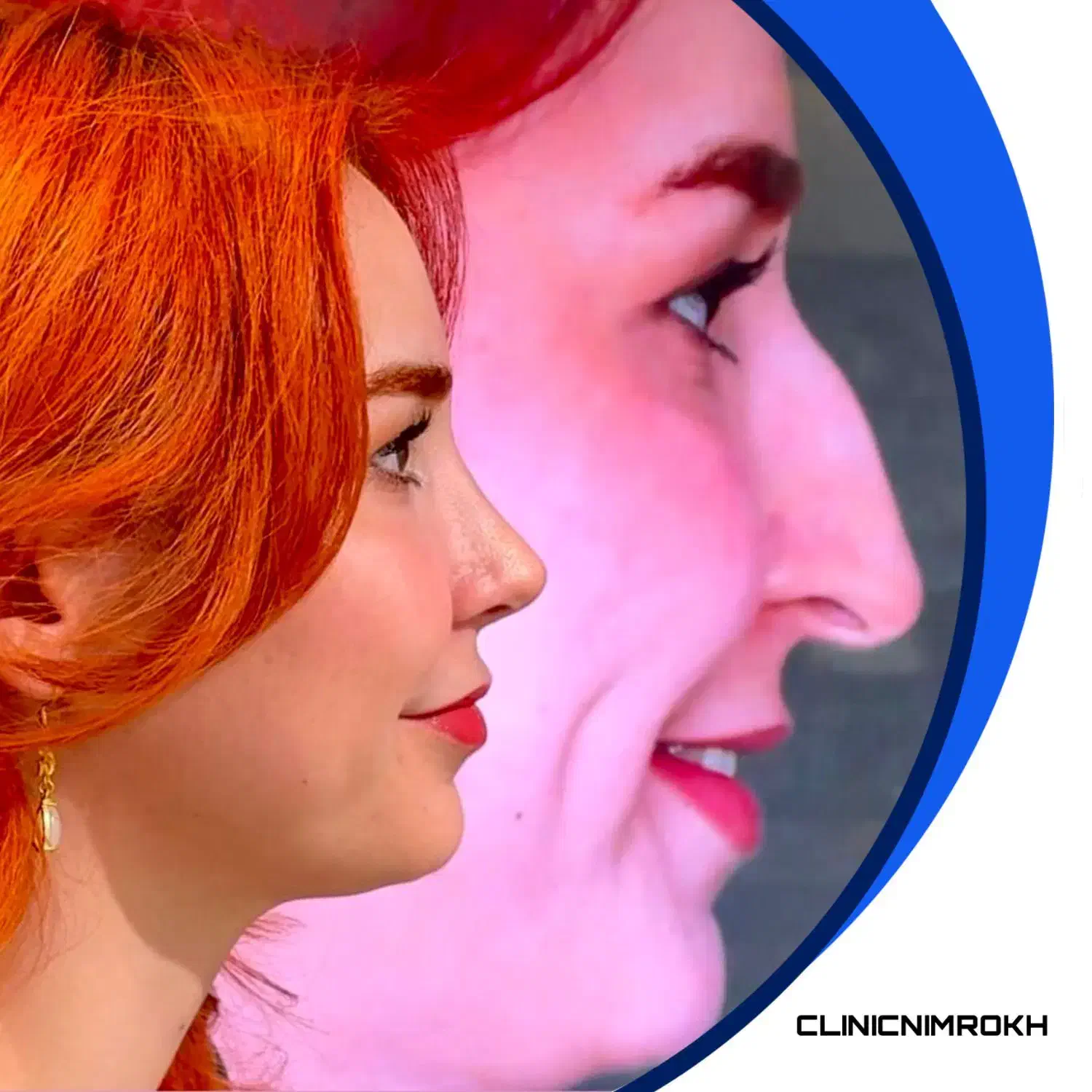 جراحی بینی با قیمت استثنایی|خدمات آرایشگری و زیبایی|بروجرد, |دیوار