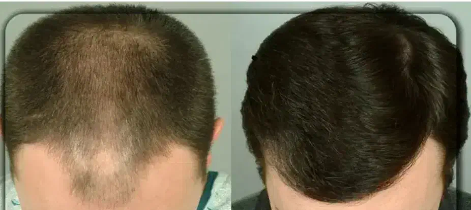 فرصت طلایی برای پوست و مو|خدمات آرایشگری و زیبایی|بوشهر, |دیوار