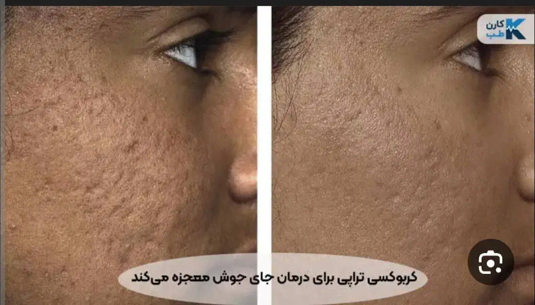 دستگاه کربن تراپی روشن کننده و از بین برنده تاتو|پزشکی|کرج, گلشهر|دیوار