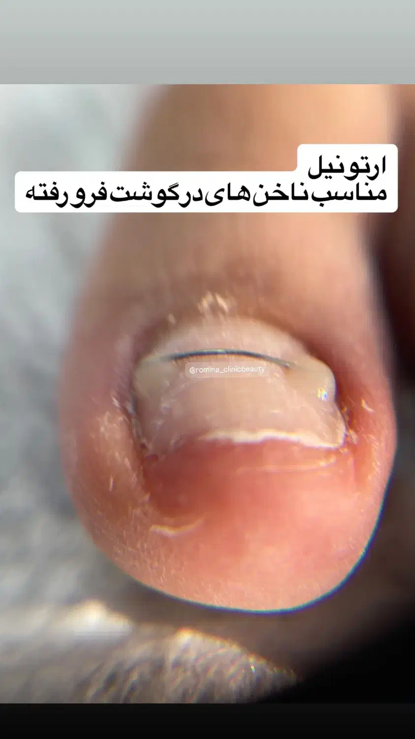 خدمات ارتونیل(ارتودنسی ناخن)وکفسابی ،درمان میخچه|خدمات آرایشگری و زیبایی|تهران, دردشت|دیوار