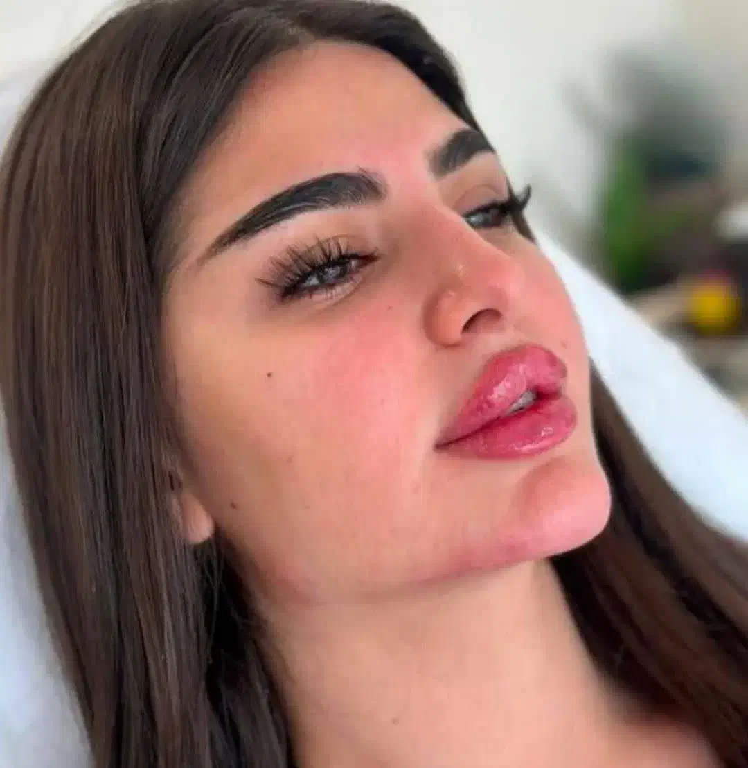 تزریق ژل دور چشم . بیکینی لیفت صورت بانخ مزوتراپی|خدمات آرایشگری و زیبایی|شاهین‌شهر, عطار|دیوار