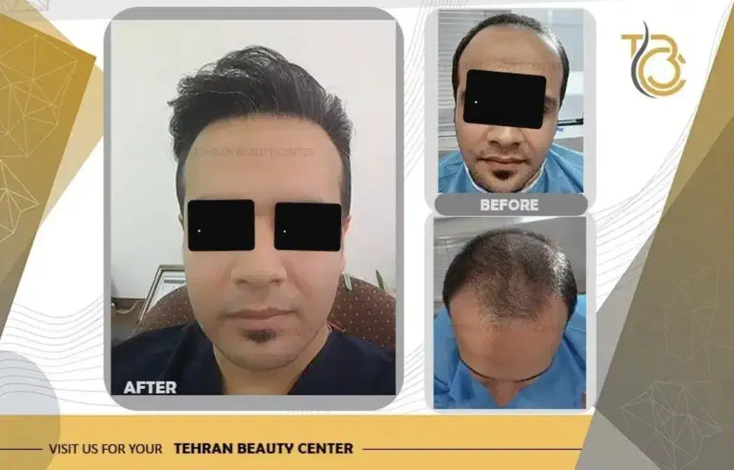 کاشت مو، کاشت ابرو، بلفارو، عمل بینی، رفع غبغب|خدمات آرایشگری و زیبایی|کرج, فاز ۱ مهرشهر|دیوار