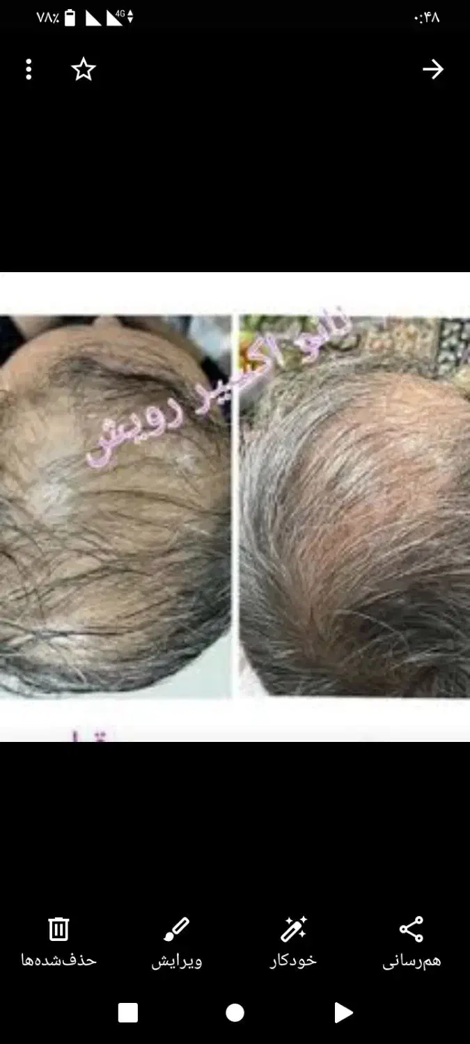 محلول و درمان رشد موی سر کاملا گیاهی|آرایشی، بهداشتی، درمانی|مهاباد (آذربایجان غربی), |دیوار