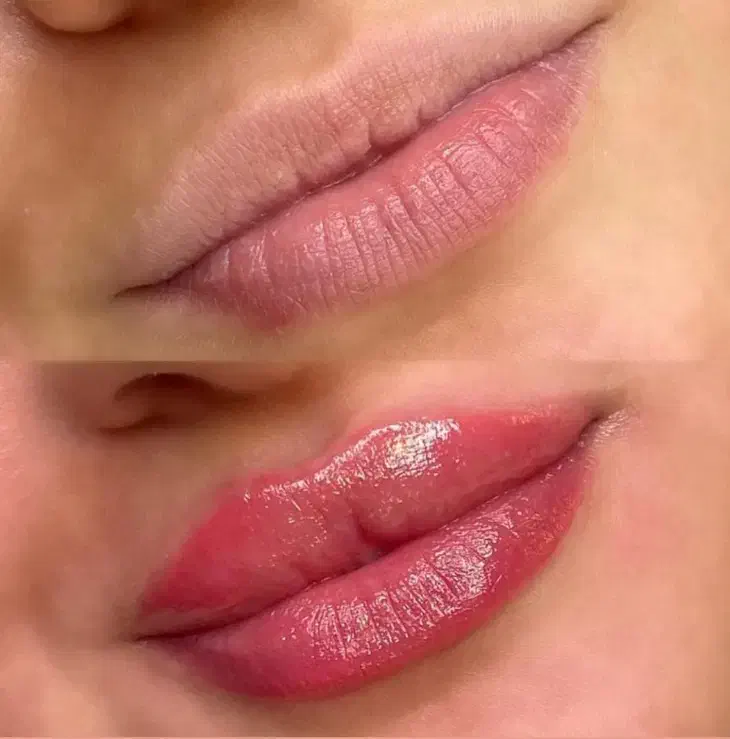 تخفیف تزریق ژل، بوتاکس در منزل|خدمات آرایشگری و زیبایی|گرگان, |دیوار