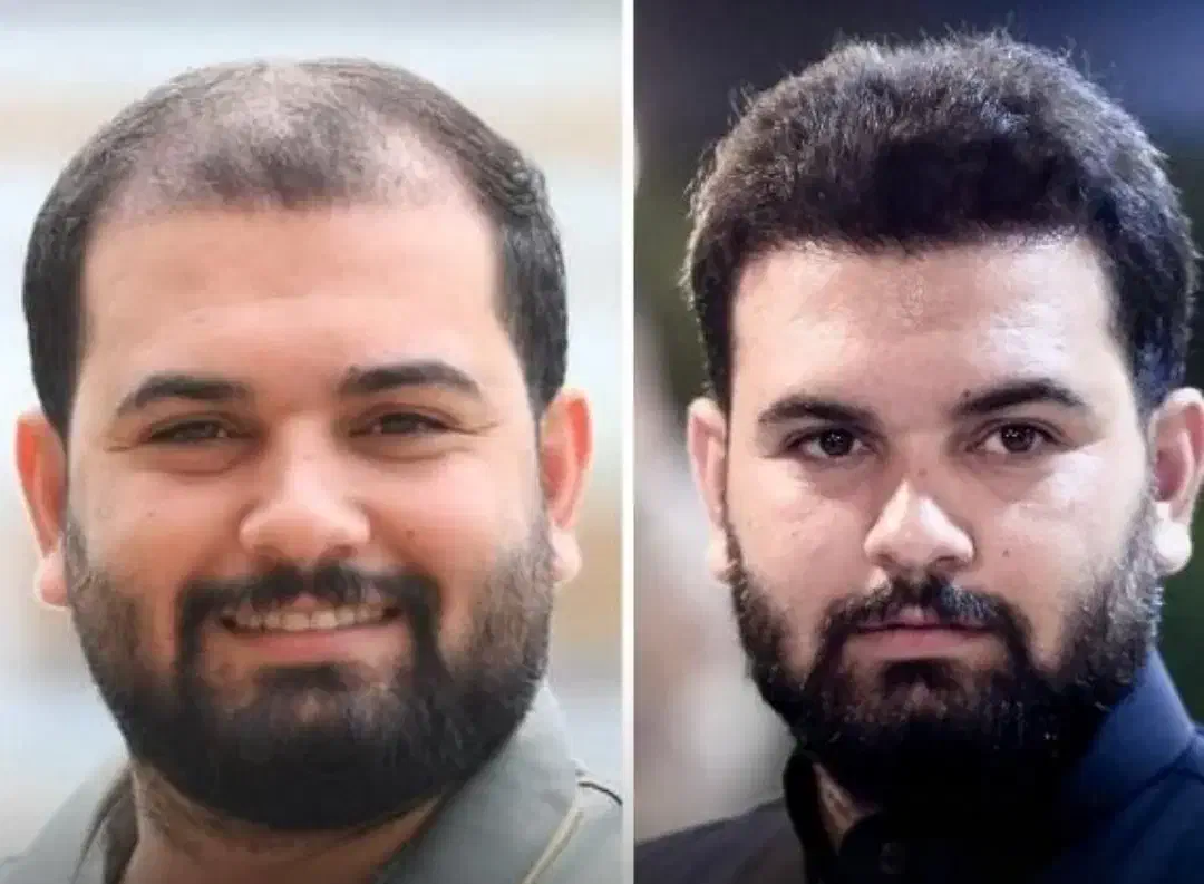 کاشت مو و ابروی طبیعی مزو و پی آرپی جلوگیری ریش مو|خدمات آرایشگری و زیبایی|تبریز, |دیوار