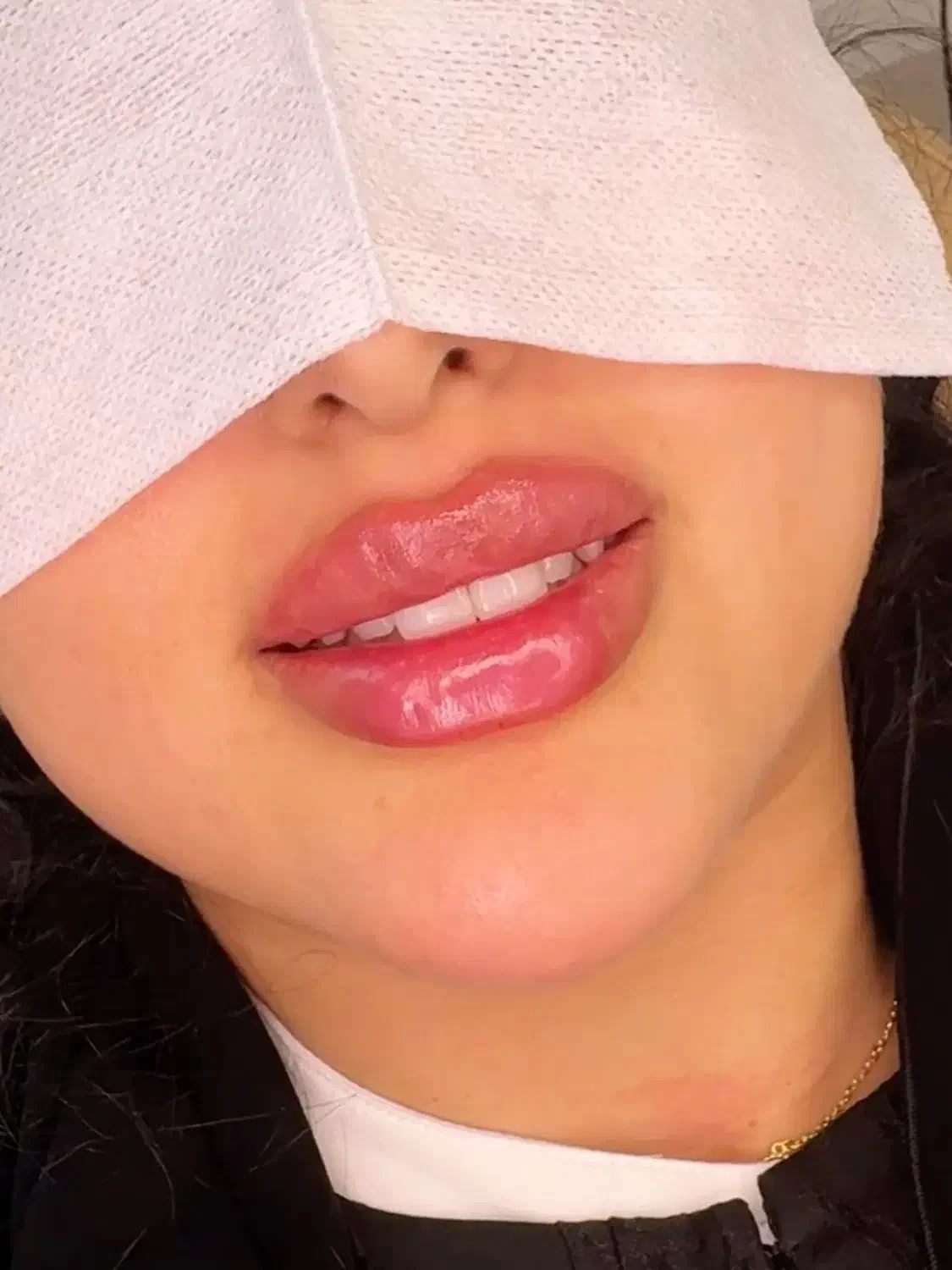 جشنواره  تزریق ژل  لب روسی وبوتاکس انزیم فیلر|خدمات آرایشگری و زیبایی|کرج, گلشهر|دیوار