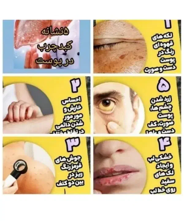 پاکسازی کبد چرب تضمینی|خدمات آرایشگری و زیبایی|گرگان, |دیوار