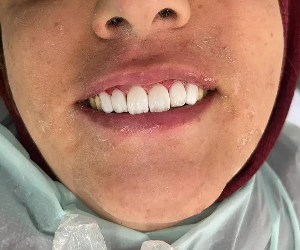 تخفیف وام دندانپزشکی ایمپلنت کامپوزیت روکش عصب کشی|خدمات آرایشگری و زیبایی|بروجرد, |دیوار