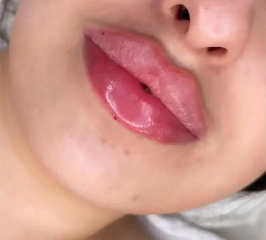 ژل وبوتاکس|خدمات آرایشگری و زیبایی|مشهد, ایثارگران|دیوار