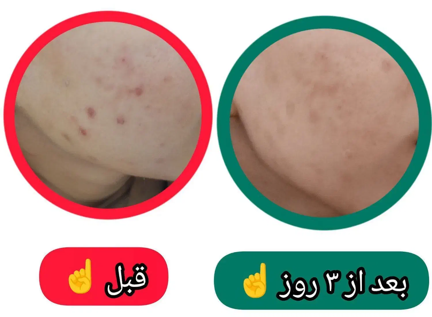 محلول ضدجوش و آکنه گیاهی|آرایشی، بهداشتی، درمانی|کاشمر, |دیوار