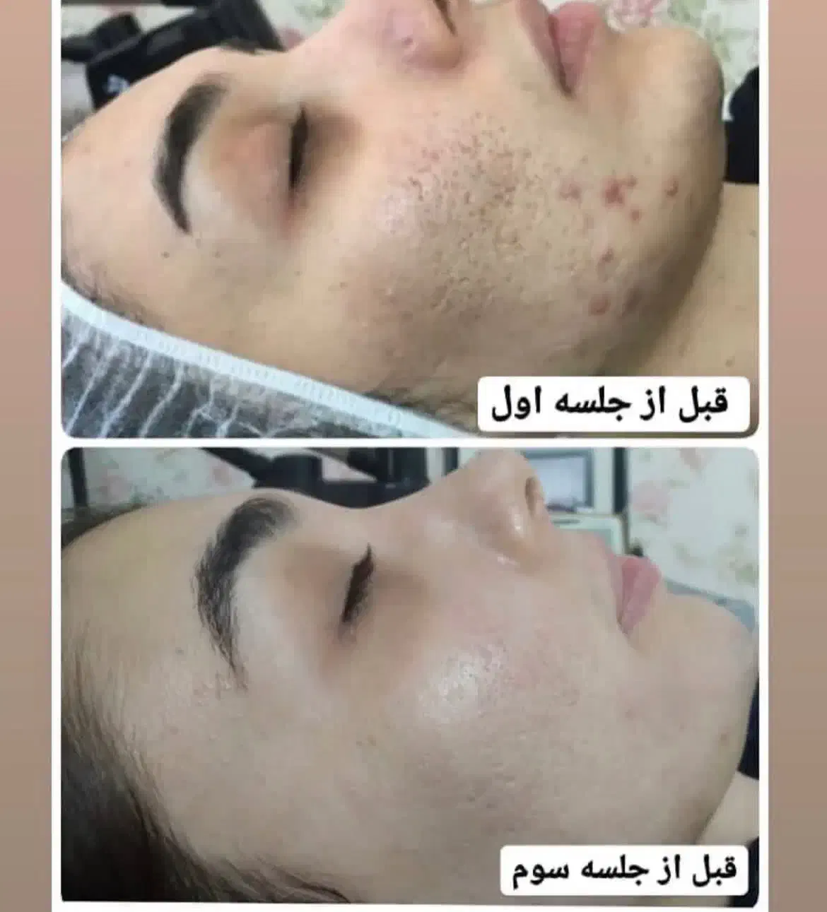 جشنواره تخفیف خدمات پوستی(فیشال،پاکسازی،کربوکسی)|خدمات آرایشگری و زیبایی|بیرجند, |دیوار