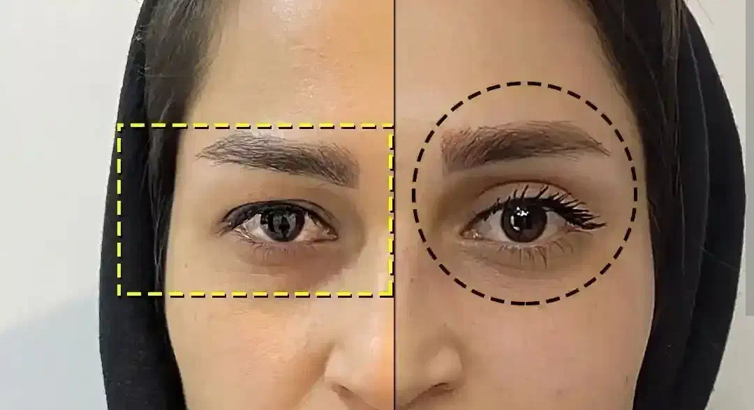 بلفارو (بخیه لیزری) ، ساکشن غبغب|خدمات آرایشگری و زیبایی|مشهد, چهارچشمه|دیوار