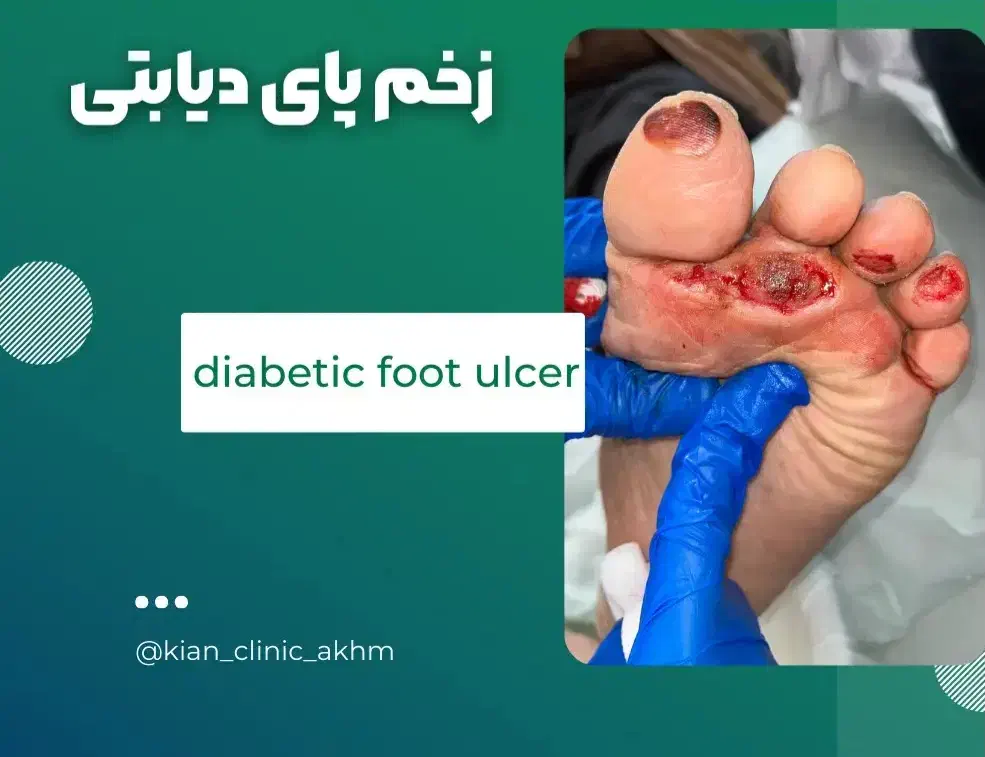 تونیک نانوحاوی کلوئیدنقره رفع زخم دیابتی وزخم بستر|آرایشی، بهداشتی، درمانی|نیشابور, ابراهیم ادهم|دیوار