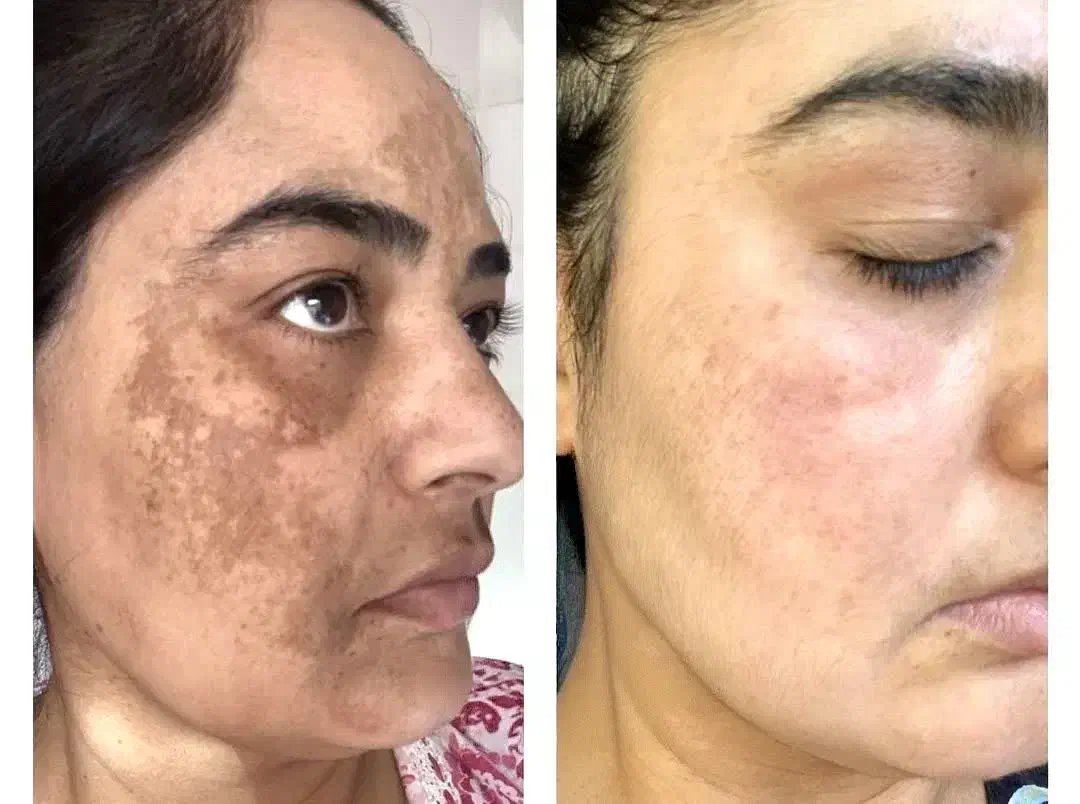 به مدل جهت انجام تکنیک آیینه سازی پوست|خدمات آرایشگری و زیبایی|ورامین, ورامین|دیوار