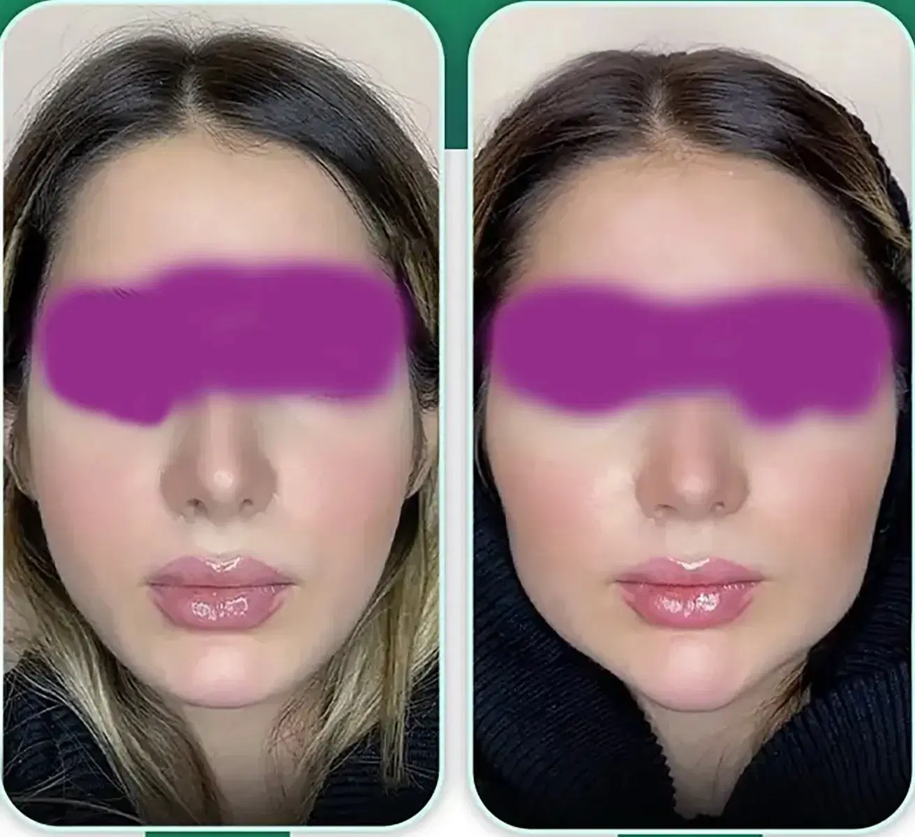 بایو فیلر متد اروپایی کلینیک فرحزاد|خدمات زیبایی و سلامت|اصفهان, عباسآباد|دیوار