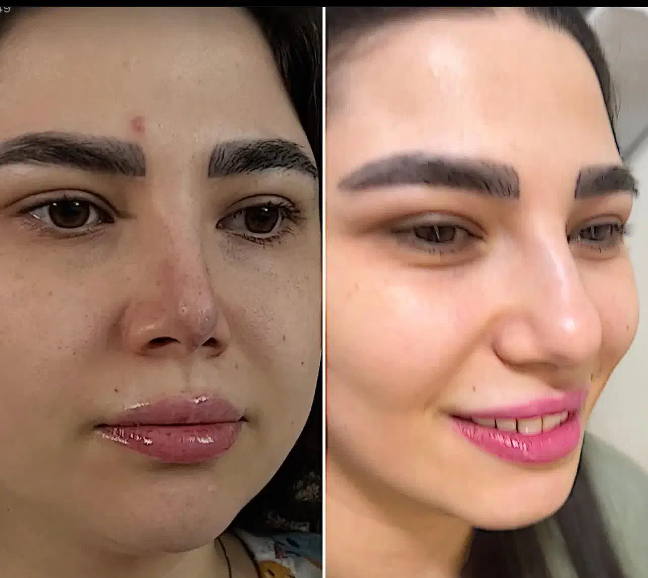 کوچک شدن بینی تضمینی فقط با ۵ میلیون|خدمات آرایشگری و زیبایی|تهران, هاشمی|دیوار